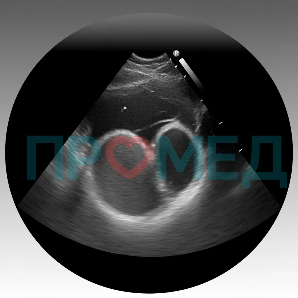 Эхокардиограмма, демонстрирующая дилатацию левого желудочка