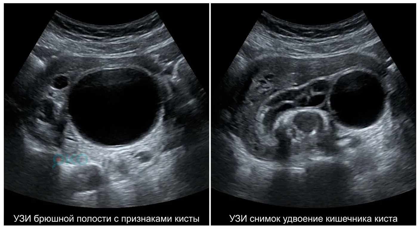 УЗИ брюшной полости с признаками кисты, УЗИ снимок удвоение кишечника киста