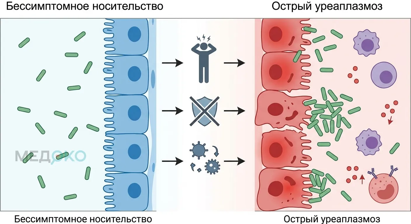 Схема перехода бессимптомного носительства уреаплазмы в острый уреаплазмоз