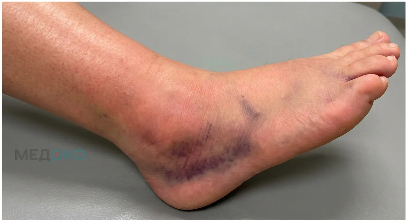 Симптомы вывиха голеностопного сустава: отек и гематома